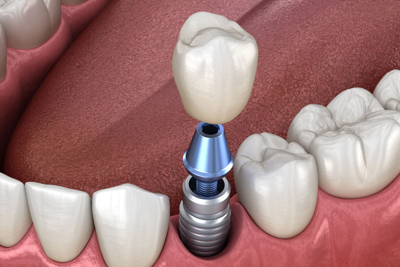 dental implant model